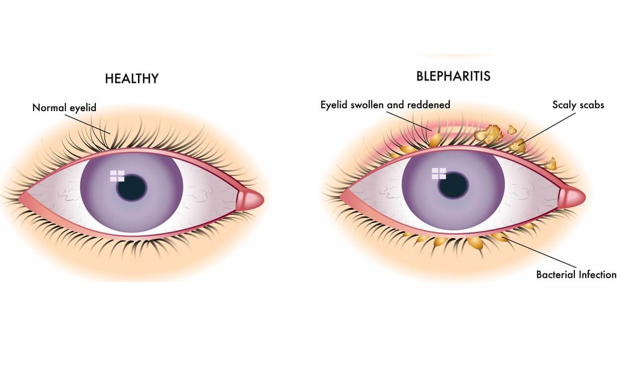 Fibromyalgia and Blepharitis - Women With Fibromyalgia