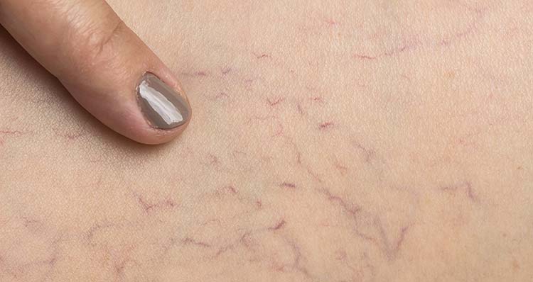 What You Need To Know About Fibromyalgia Spider Veins